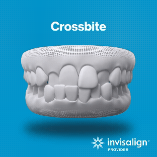 Crossbite