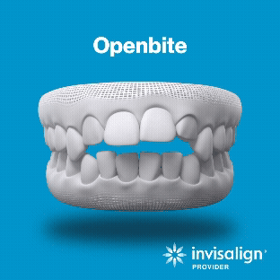 Openbite