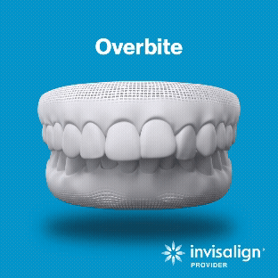Overbite