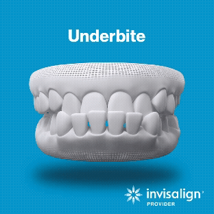 Underbite